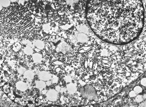 F,39y. | metastatic alveolar sarcoma of soft parts F,39y. | metastatic alveolar sarcoma of soft parts